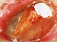 Bone 3 with cholesteatoma.